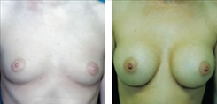 Breast Procedures Patient Before & After Photo 1