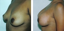 Breast Augmentation Patient Before & After Photo 1