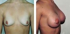 Breast Procedures Patient Before & After Photo 1