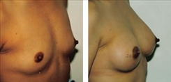 Breast Augmentation Patient Before & After Photo 1