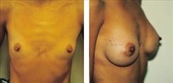 Breast Augmentation Patient Before & After Photo 1