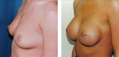 Breast Procedures Patient Before & After Photo 1