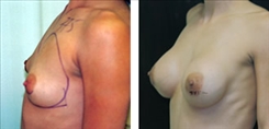 Breast Procedures Patient Before & After Photo 1