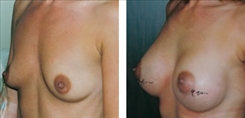 Breast Procedures Patient Before & After Photo 1