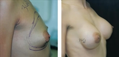 Breast Procedures Patient Before & After Photo 1