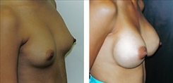 Breast Augmentation Patient Before & After Photo 1