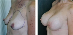 Breast Augmentation Patient Before & After Photo 1