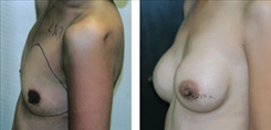 Breast Procedures Patient Before & After Photo 1