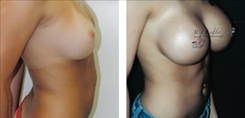 Breast Procedures Patient Before & After Photo 1