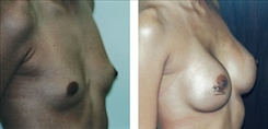 Breast Procedures Patient Before & After Photo 1