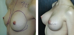 Breast Procedures Patient Before & After Photo 1