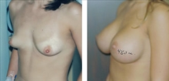 Breast Procedures Patient Before & After Photo 1