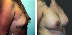 Breast Procedures Patient Before & After Photo 1