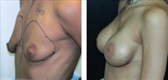 Breast Procedures Patient Before & After Photo 1