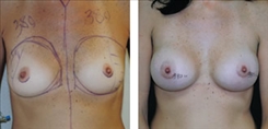 Breast Procedures Patient Before & After Photo 1