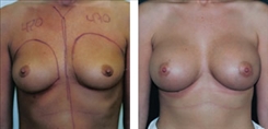 Breast Procedures Patient Before & After Photo 1