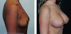 Breast Augmentation Patient Before & After Photo 1