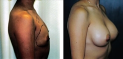 Breast Augmentation Patient Before & After Photo 1