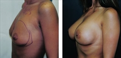 Breast Augmentation Patient Before & After Photo 1