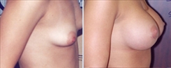 Breast Procedures Patient Before & After Photo 1