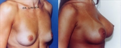 Breast Augmentation Patient Before & After Photo 1