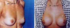 Breast Procedures Patient Before & After Photo 1