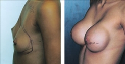 Breast Augmentation Patient Before & After Photo 1