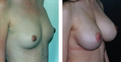 Breast Augmentation Patient Before & After Photo 1