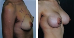 Breast Augmentation Patient Before & After Photo 1