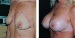 Breast Procedures Patient Before & After Photo 1