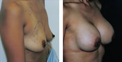 Breast Augmentation Patient Before & After Photo 1