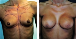 Breast Procedures Patient Before & After Photo 1