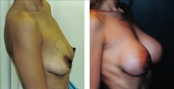 Breast Augmentation Patient Before & After Photo 1