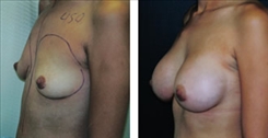 Breast Augmentation Patient Before & After Photo 1