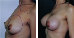 Breast Augmentation Patient Before & After Photo 1