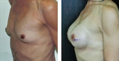 Breast Augmentation Patient Before & After Photo 1