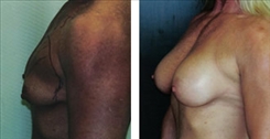 Breast Augmentation Patient Before & After Photo 1