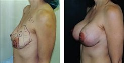 Breast Augmentation Patient Before & After Photo 1