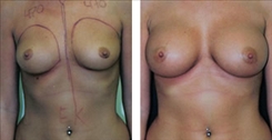 Breast Augmentation Patient Before & After Photo 1