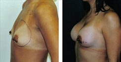 Breast Augmentation Patient Before & After Photo 1