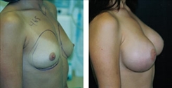 Breast Augmentation Patient Before & After Photo 1