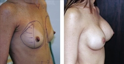 Breast Augmentation Patient Before & After Photo 1