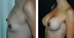 Breast Augmentation Patient Before & After Photo 1