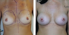 Breast Augmentation Patient Before & After Photo 1