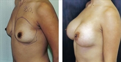 Breast Augmentation Patient Before & After Photo 1