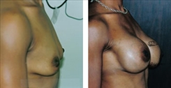 Breast Augmentation Patient Before & After Photo 1