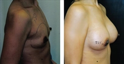 Breast Augmentation Patient Before & After Photo 1