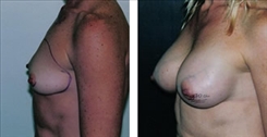 Breast Augmentation Patient Before & After Photo 1