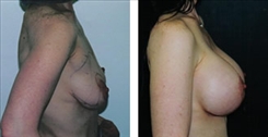 Breast Augmentation Patient Before & After Photo 1