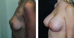 Breast Augmentation Patient Before & After Photo 1